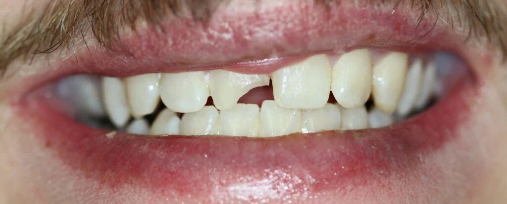 Patient Smile Case 2 before treatment