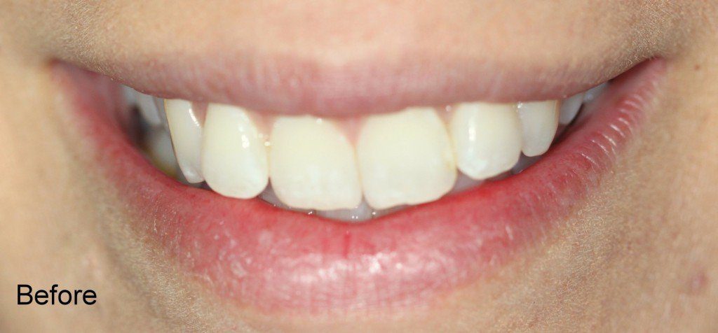 Patient Smile Case 3 before treatment