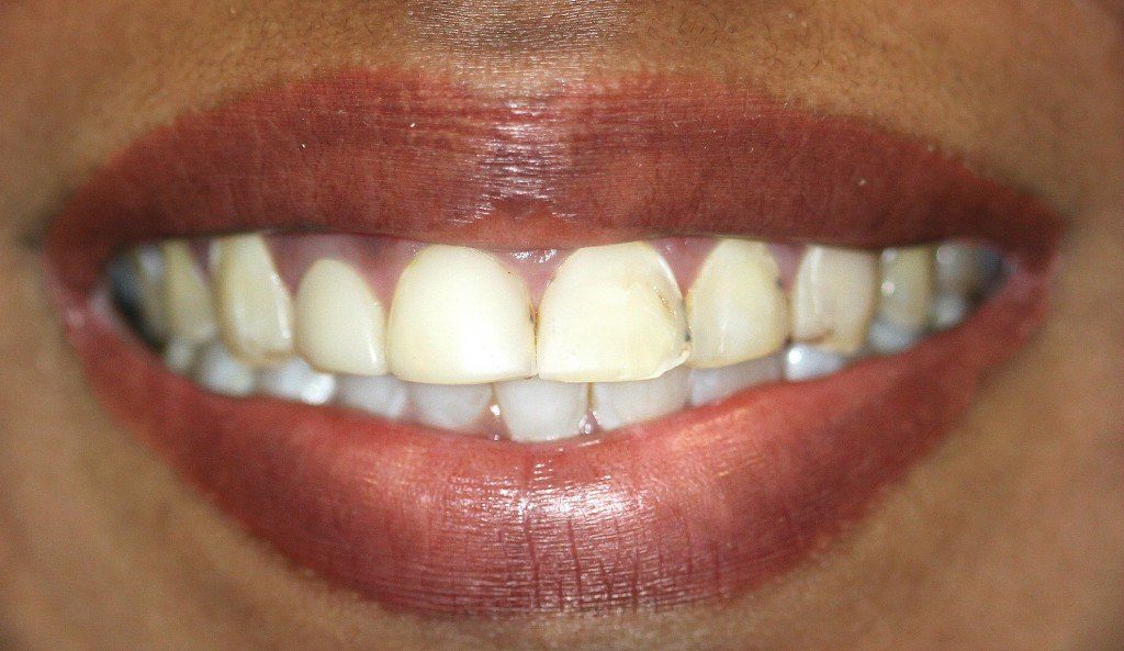 Patient Smile Case 5 before treatment