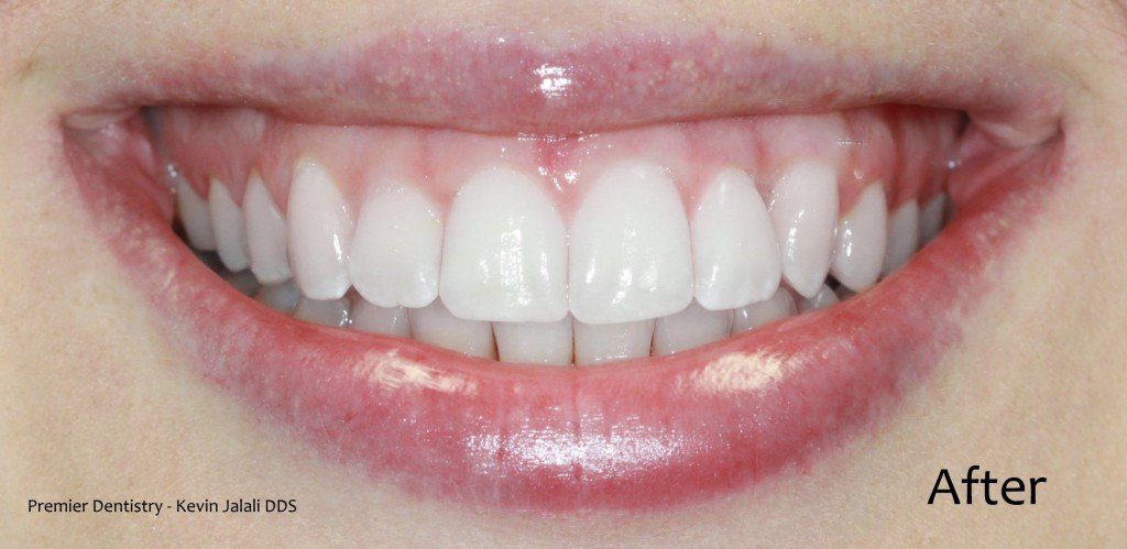 Patient Smile Case 6 after treatment