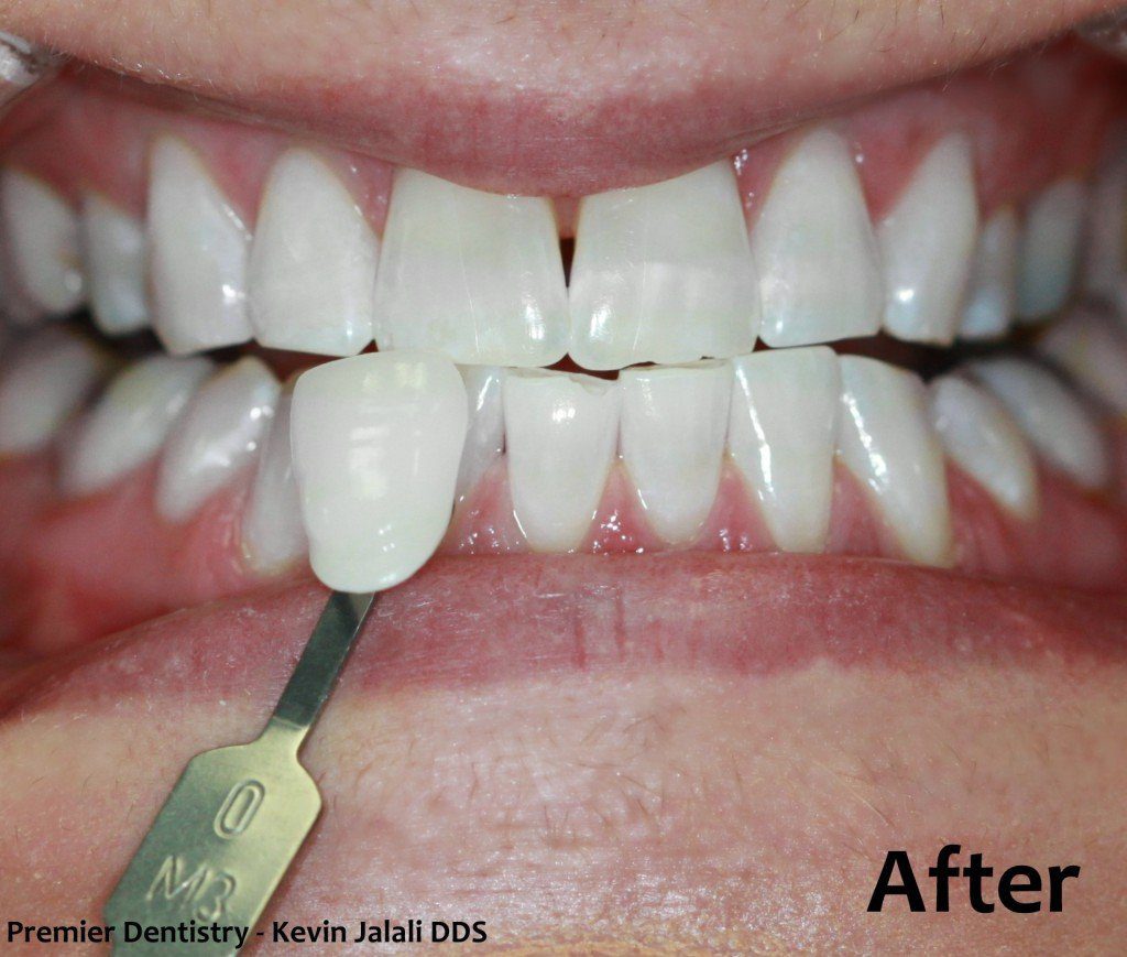 Patient Smile Case 7 after treatment