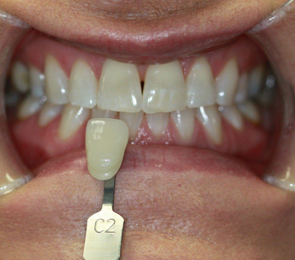Patient Smile Case 7 before treatment