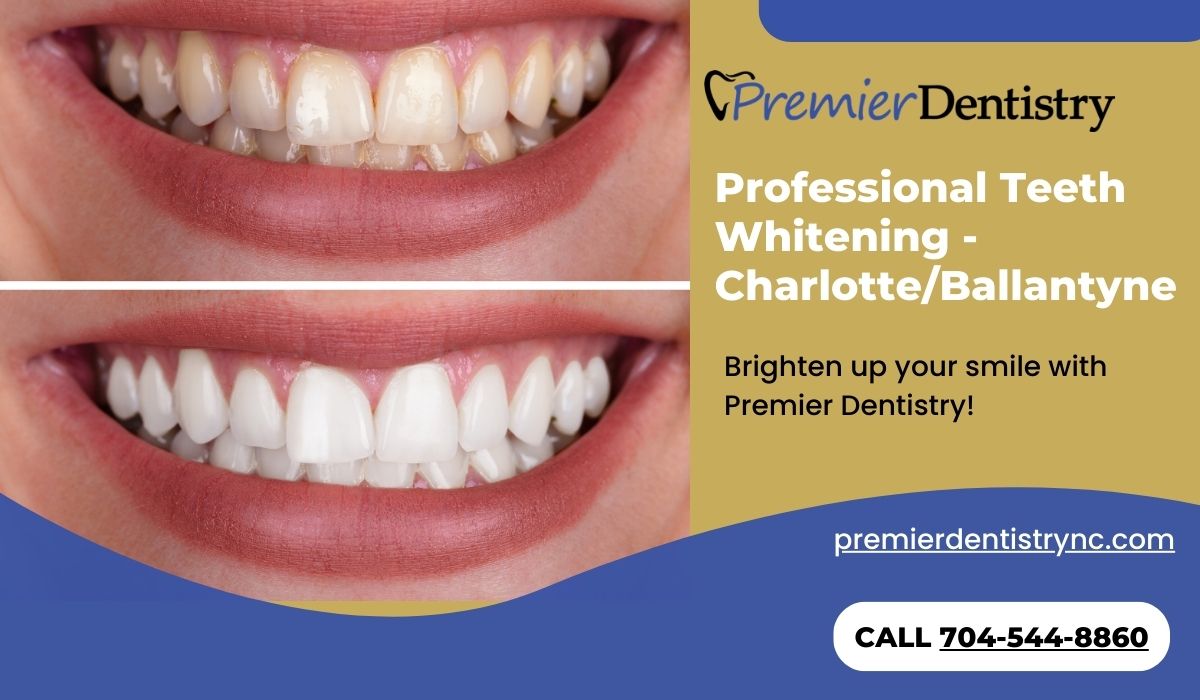 Professional Teeth Whitening Charlotte/Ballantyne Premier Dentistry